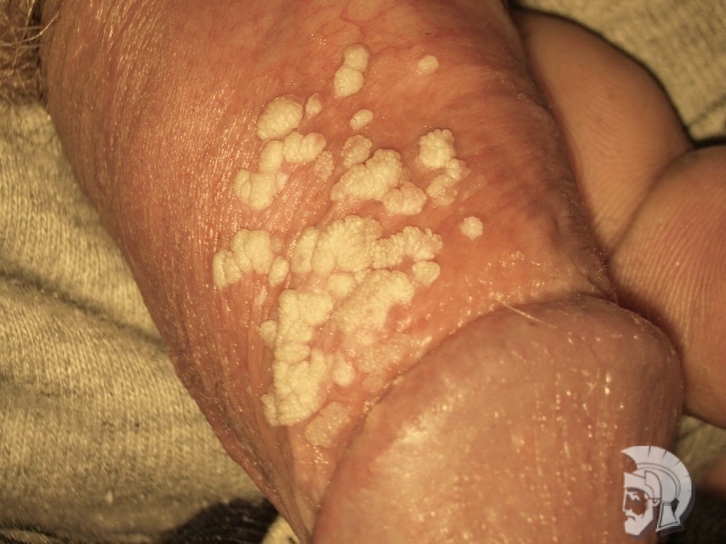 Фото кондиломы у мужчин. Тот же случай. Множественные папилломы крайней плоти после безболезненной обработки деструктуризирующим средством